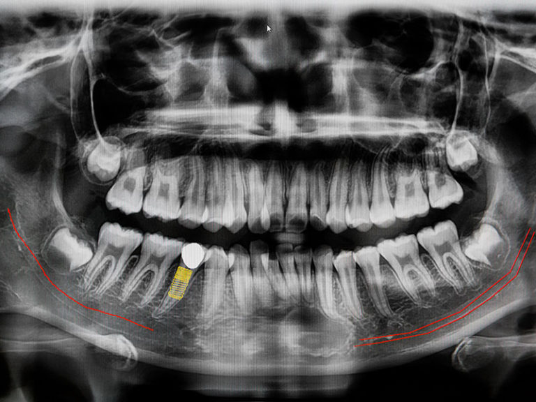 digital-x-ray-of-jaw-with-implant-tooth