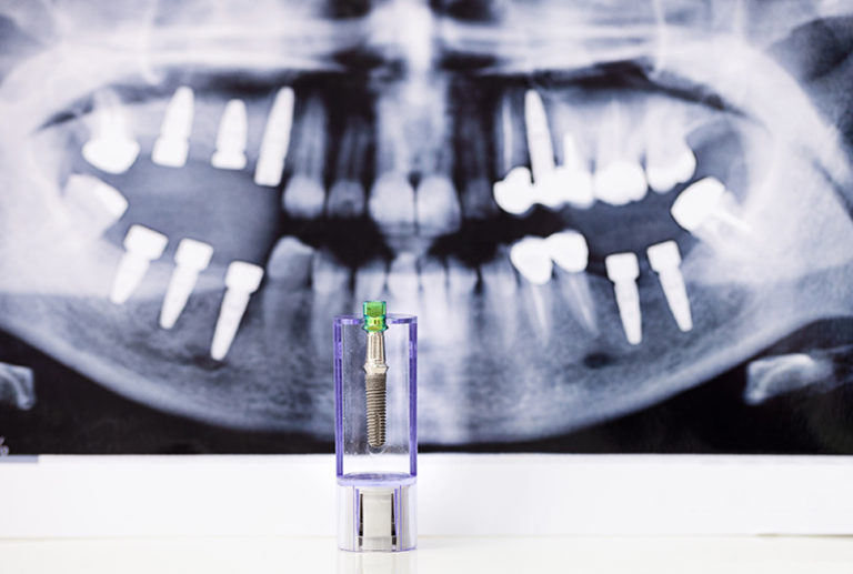 dental-implant-and-x-ray-picture-as-background-PMMWWMR