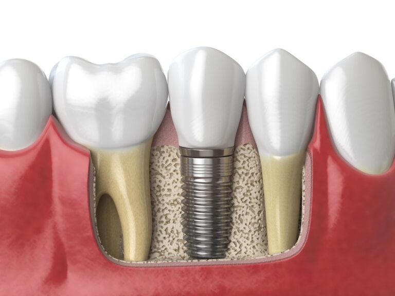 anatomy of healthy teeth and tooth dental implant 2023 11 27 05 23 40 utc 1