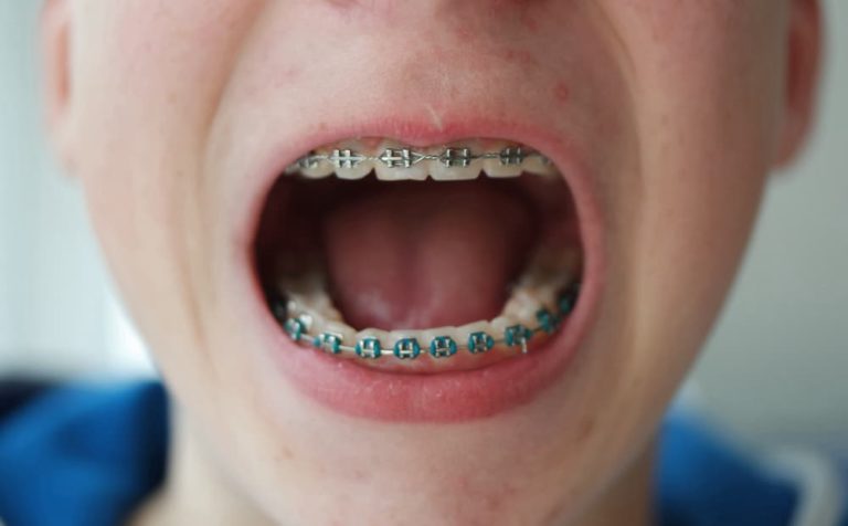 mouth open with teeth and braces teenage skin be 2021 08 30 10 16 45 utc 1