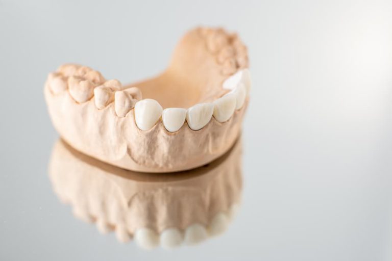 model of artificial jaw with veneers 2021 09 01 14 47 53 utc 1